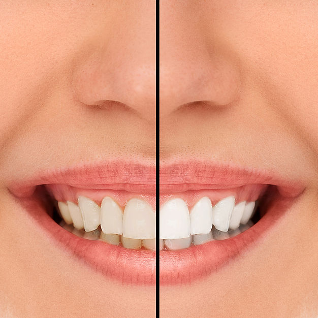 Free tooth whitening with all new Invisalign Starts | NA Orthodontics